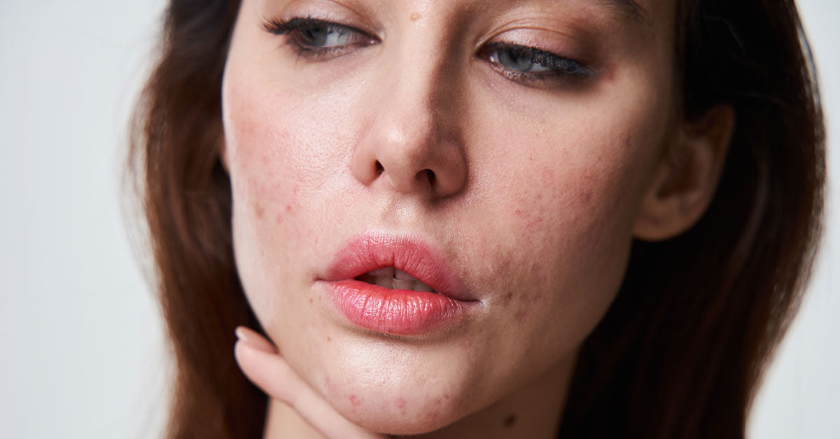 How To Get Rid Of Bumpy Skin On The Face