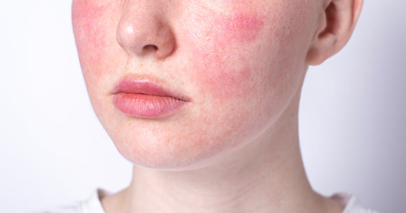 Understanding the Types of Rosacea: Key Symptoms and Treatments